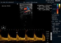 Duplexsonographie der Halsschlagader – Carotisstenose
